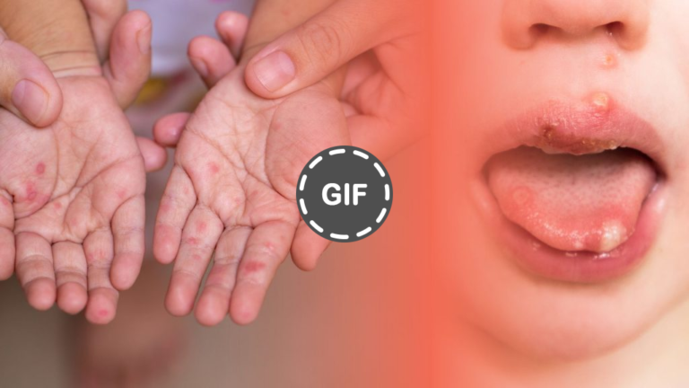 Penyakit Menular Anak Yang Sering Dianggap Remeh, Tapi Harus Diwaspadai » Dashofinsight Penyakit Menular Anak Yang Sering Dianggap Remeh, Tapi Harus Diwaspadai » Dashofinsight