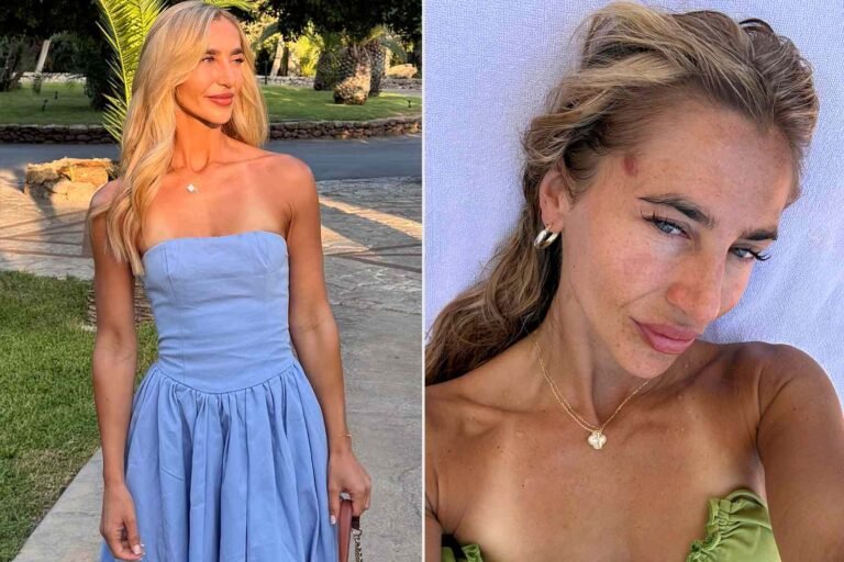 Woman Used Tanning Beds Weekly for 6 Years. At Age 22, She Mistook a Red Patch for Eczema, but It Was Skin Cancer Woman Used Tanning Beds Weekly for 6 Years. At Age 22, She Mistook a Red Patch for Eczema, but It Was Skin Cancer